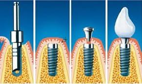 Этапы имплантации зубов