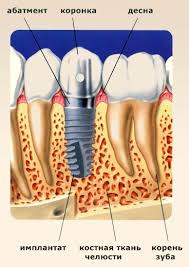 Отсутствие зубов имплантация